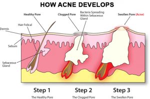 how-acne-develops