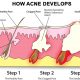 how acne develops
